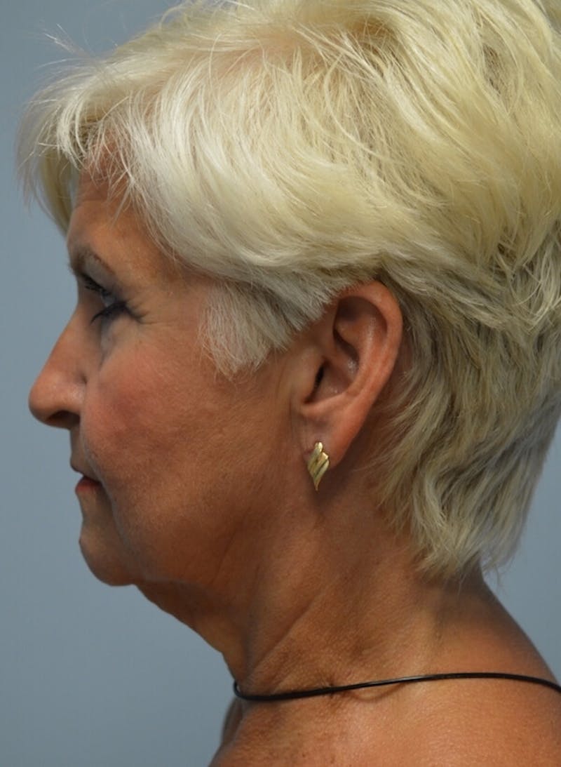 Ultherapy (Non-invasive Skin Tightening) Before & After Gallery - Patient 363767 - Image 4