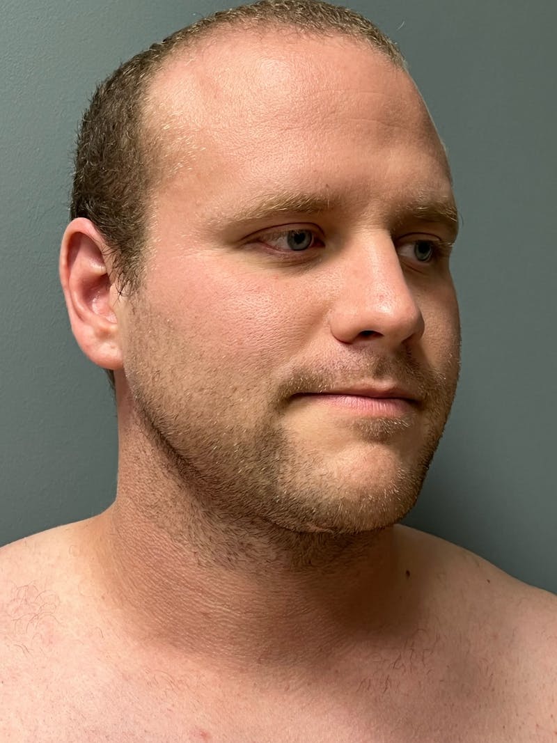 Deep Plane Neck Lift Before & After Gallery - Patient 171087 - Image 4