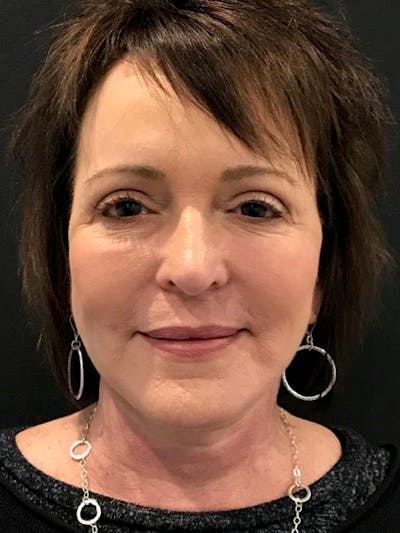 Facelift Before & After Gallery - Patient 115290 - Image 2