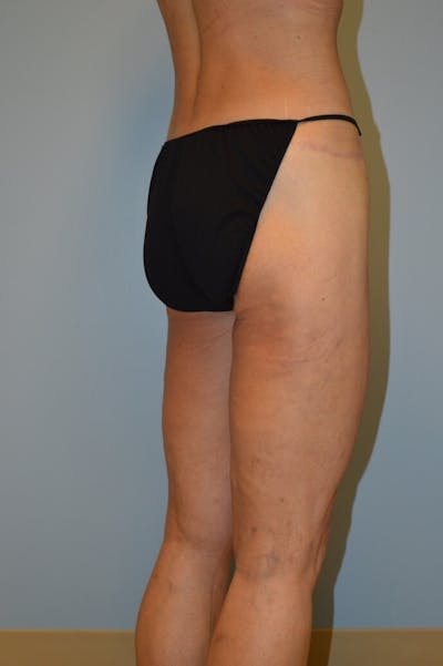 BodyTite (Scarless Skin Tightening) Before & After Gallery - Patient 207806 - Image 2