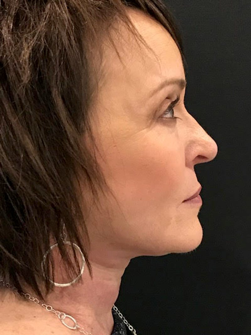 Neck Lift Before & After Gallery - Patient 211559 - Image 6