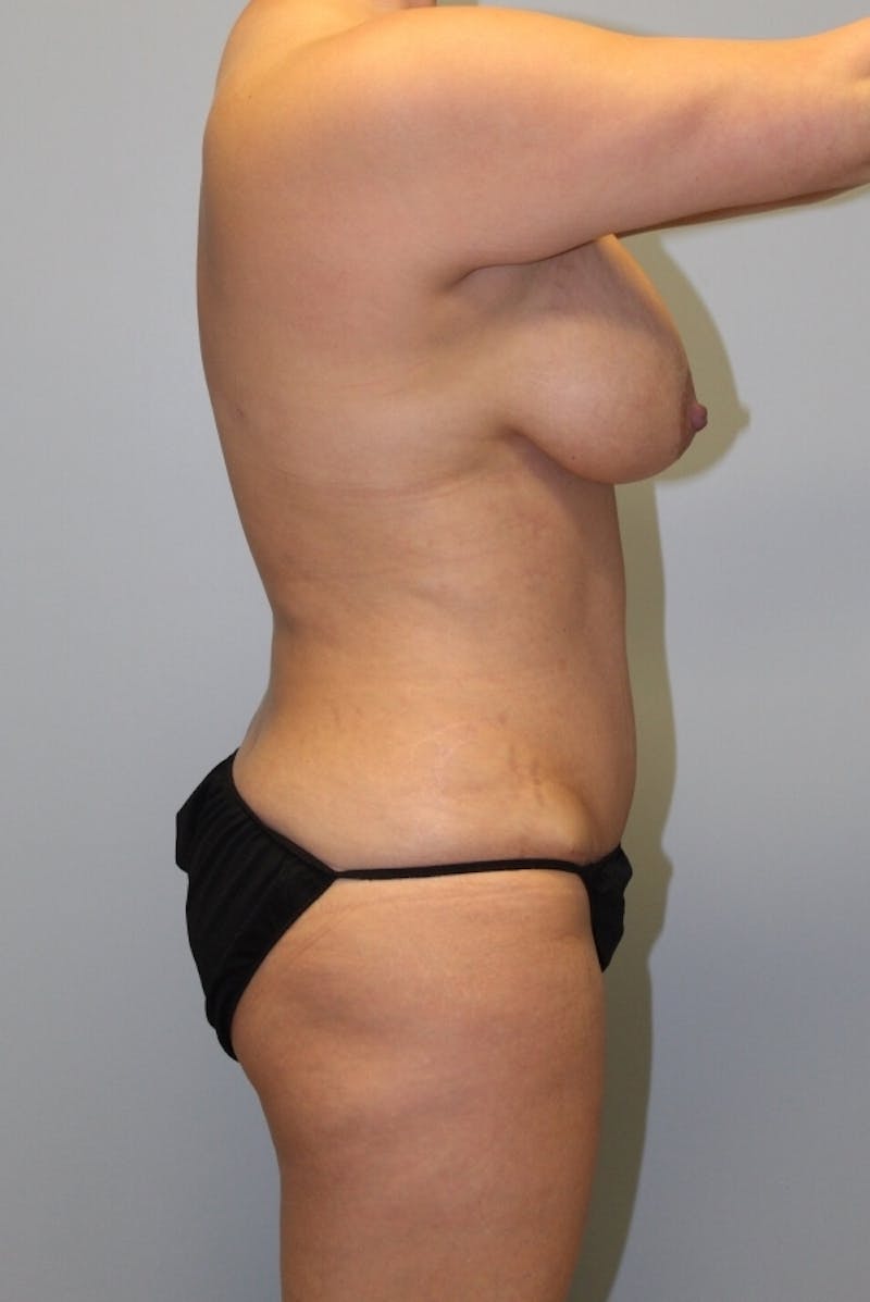 Tummy Tuck Before & After Gallery - Patient 149740 - Image 4
