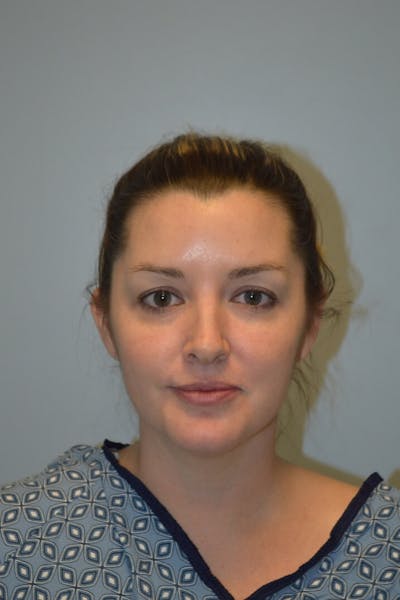FaceTite (Non-Invasive Skin Tightening) Before & After Gallery - Patient 334172 - Image 1