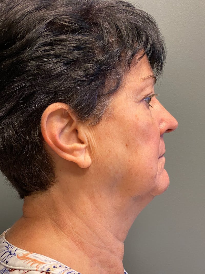 Deep Plane Facelift Before & After Gallery - Patient 717019 - Image 5
