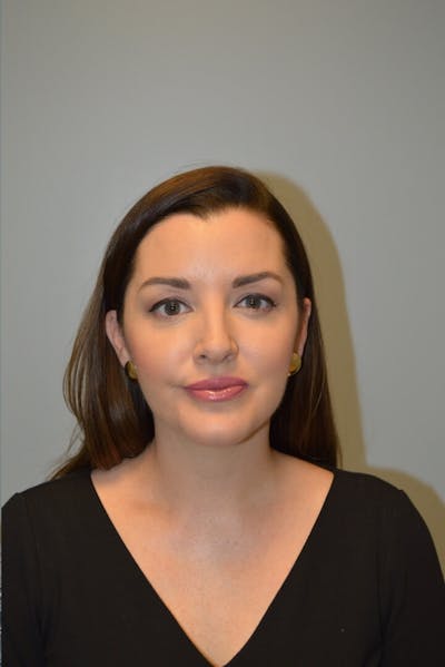 FaceTite (Non-Invasive Skin Tightening) Before & After Gallery - Patient 334172 - Image 2