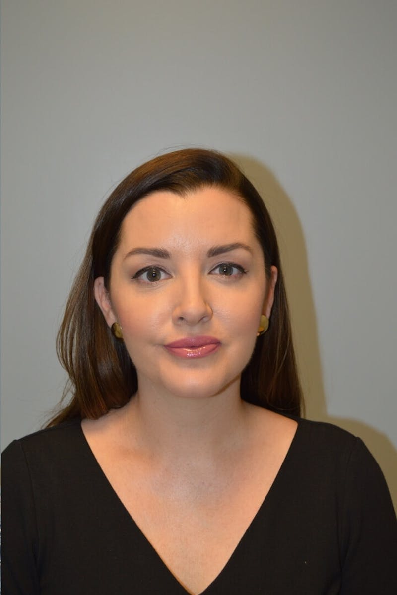 FaceTite (Non-Invasive Skin Tightening) Before & After Gallery - Patient 334172 - Image 2