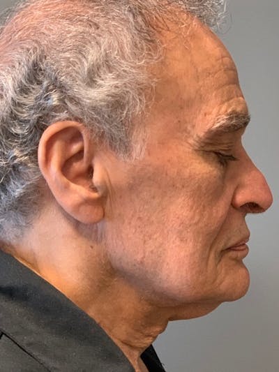 Neck Lift Before & After Gallery - Patient 291478 - Image 1