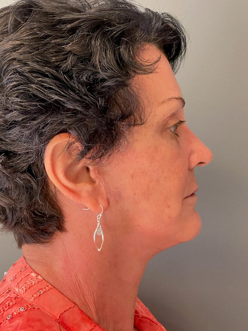 Deep Plane Facelift Before & After Gallery - Patient 717019 - Image 6