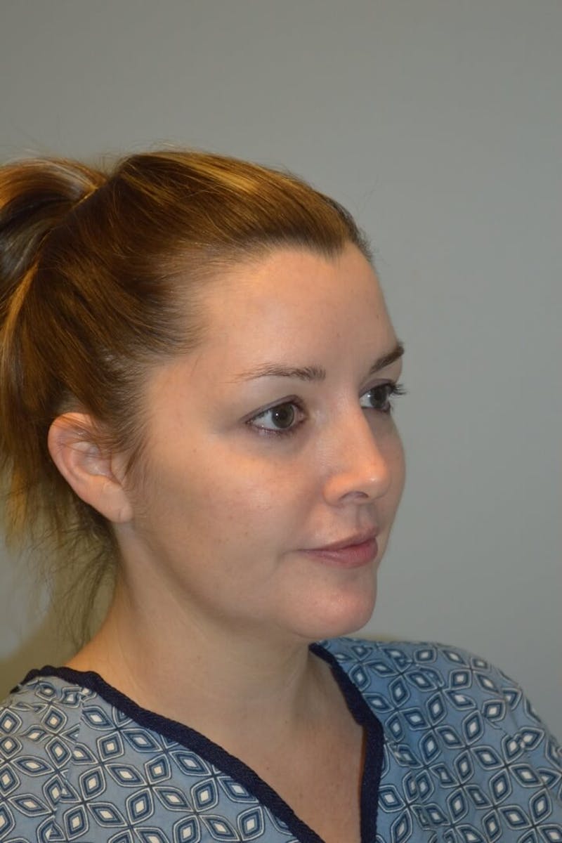 FaceTite (Non-Invasive Skin Tightening) Before & After Gallery - Patient 334172 - Image 3