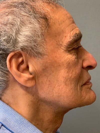 Neck Lift Before & After Gallery - Patient 291478 - Image 2
