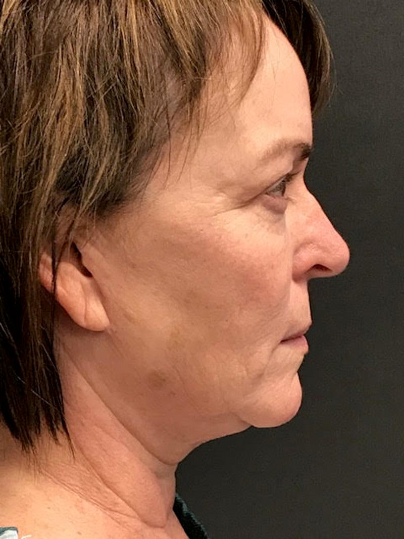Facelift Before & After Gallery - Patient 115290 - Image 5