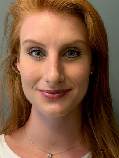 Rhinoplasty Before & After Gallery - Patient 186794 - Image 2