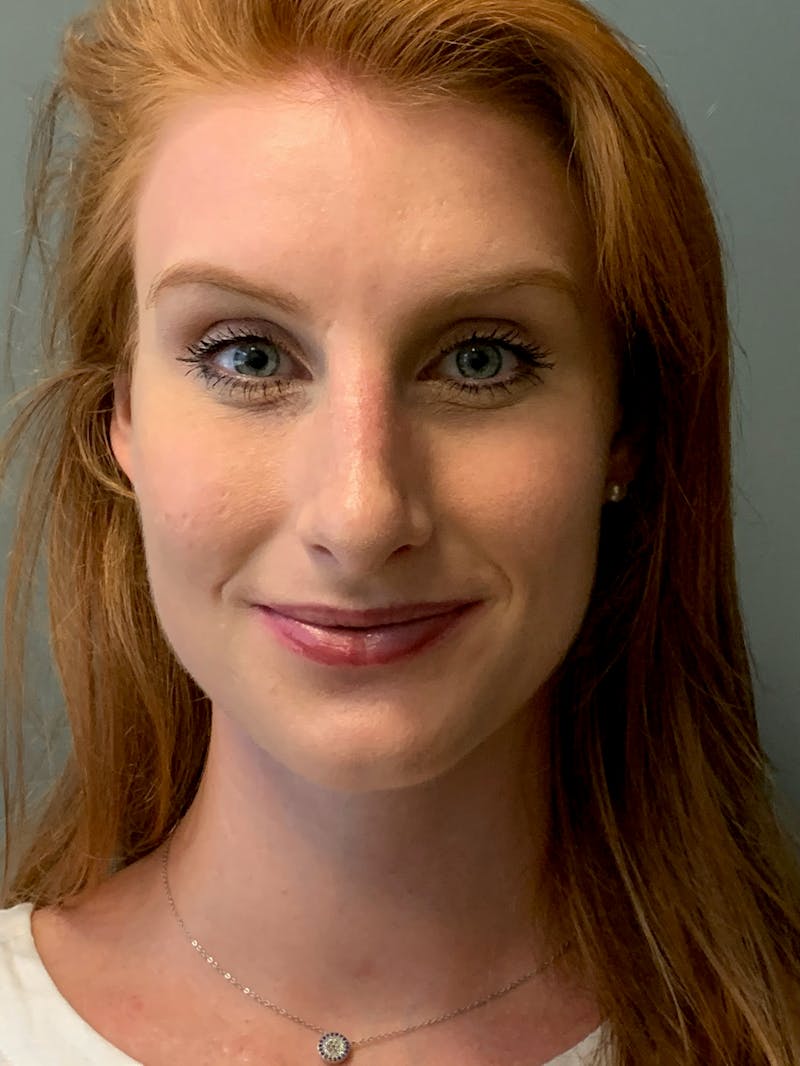 Rhinoplasty Before & After Gallery - Patient 186794 - Image 2