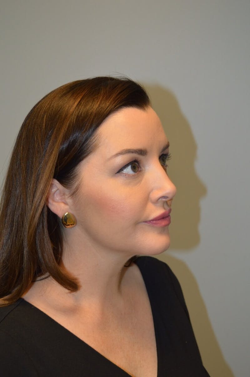 FaceTite (Non-Invasive Skin Tightening) Before & After Gallery - Patient 334172 - Image 4