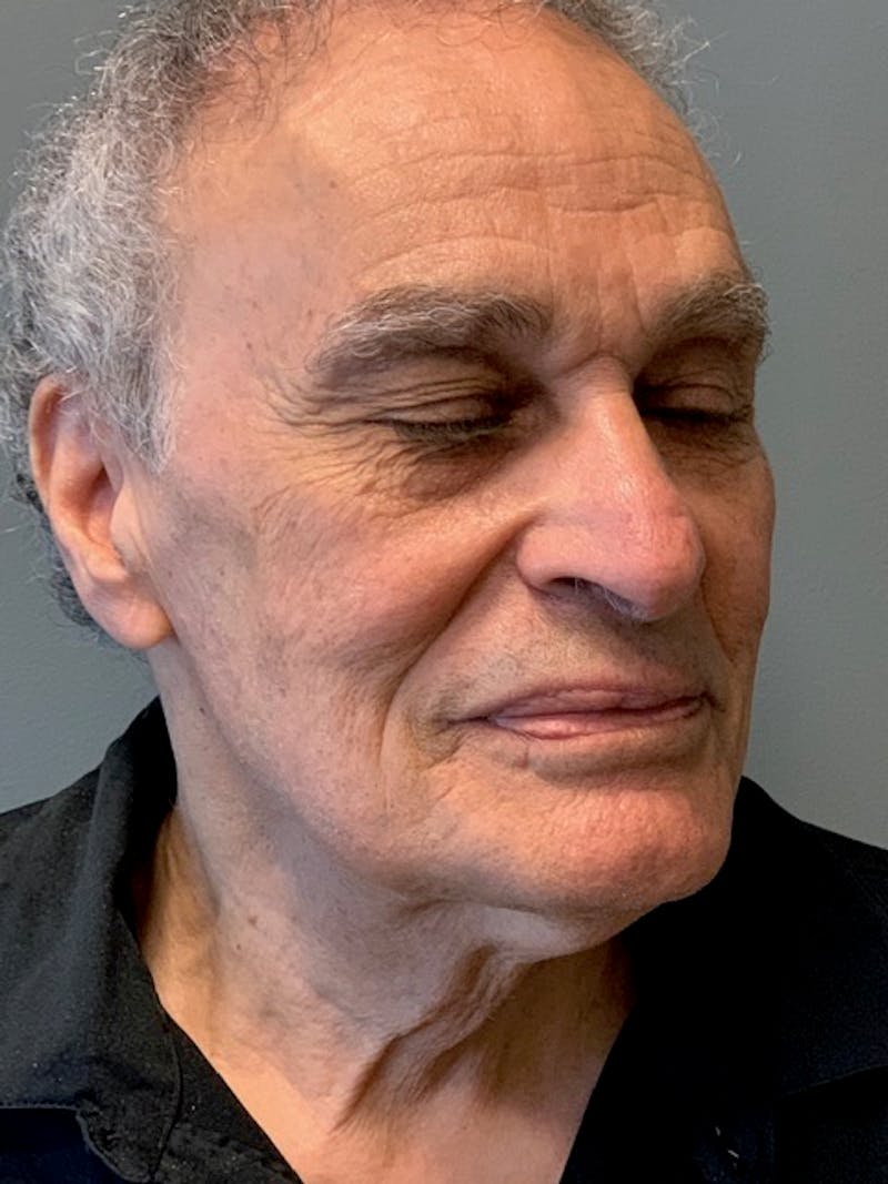 Neck Lift Before & After Gallery - Patient 291478 - Image 3