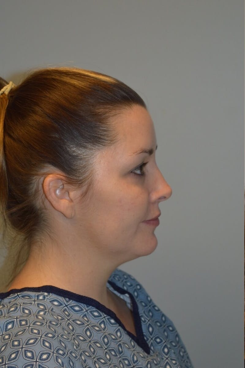 FaceTite (Non-Invasive Skin Tightening) Before & After Gallery - Patient 334172 - Image 5
