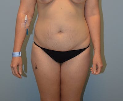 Tummy Tuck Before & After Gallery - Patient 429423 - Image 1