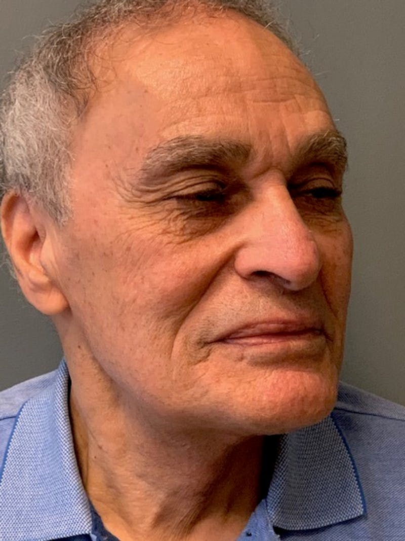 Neck Lift Before & After Gallery - Patient 291478 - Image 4