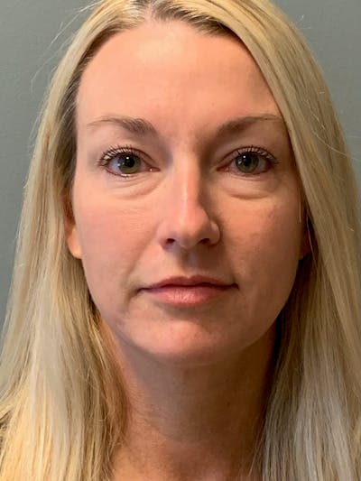 Blepharoplasty Before & After Gallery - Patient 387357 - Image 1