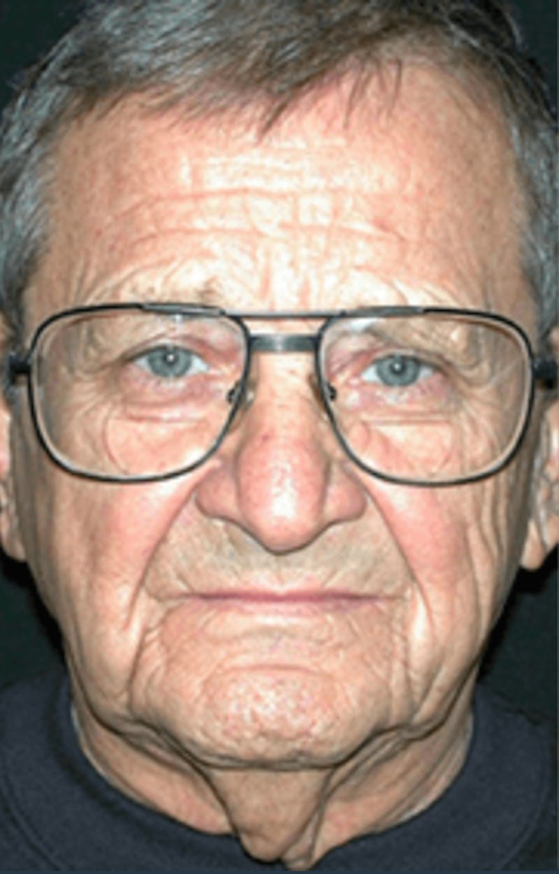 Facelift Before & After Gallery - Patient 106873 - Image 1
