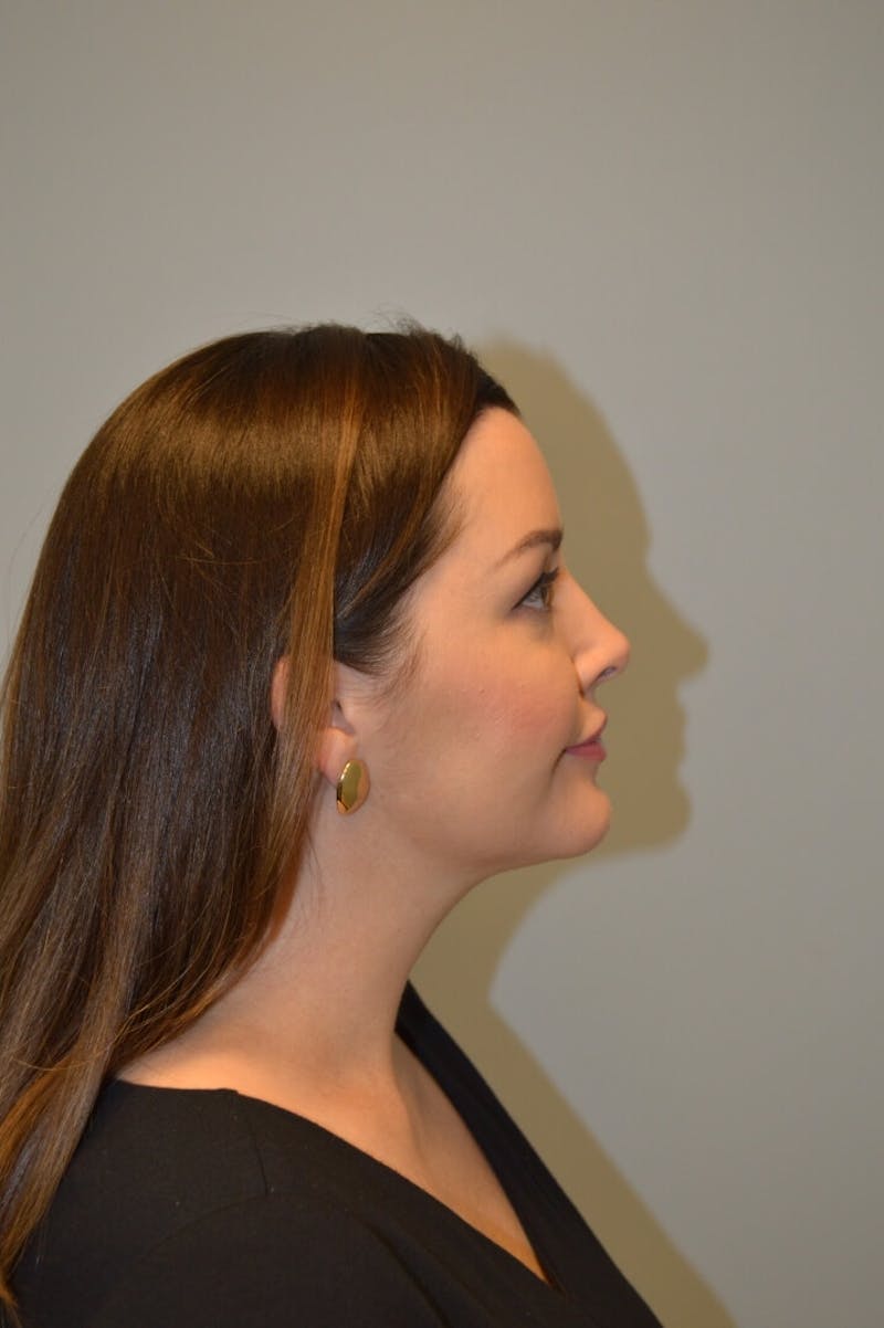 FaceTite (Non-Invasive Skin Tightening) Before & After Gallery - Patient 334172 - Image 6