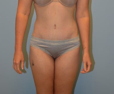 Tummy Tuck Before & After Gallery - Patient 429423 - Image 2
