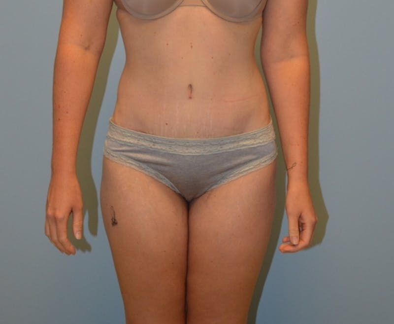 Tummy Tuck Before & After Gallery - Patient 429423 - Image 2