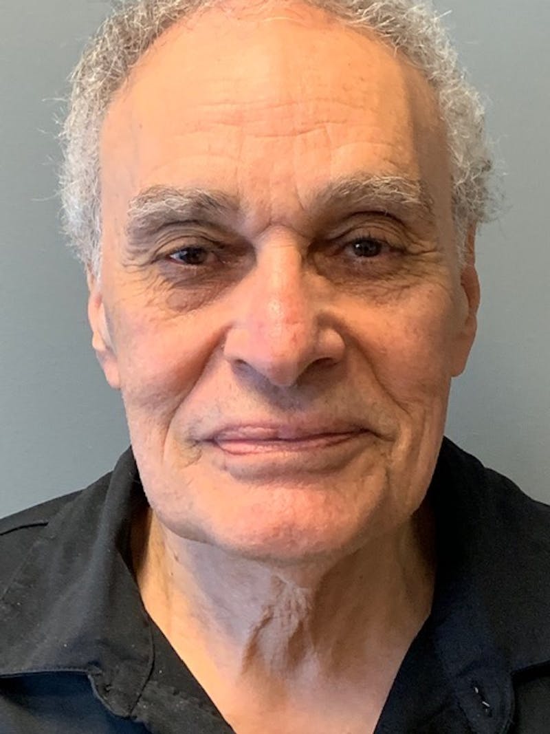 Neck Lift Before & After Gallery - Patient 291478 - Image 5