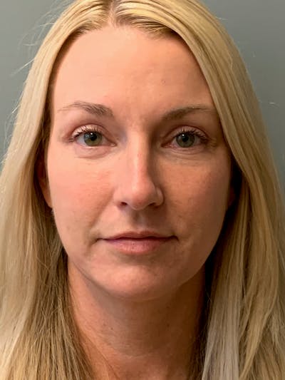 Blepharoplasty Before & After Gallery - Patient 387357 - Image 2