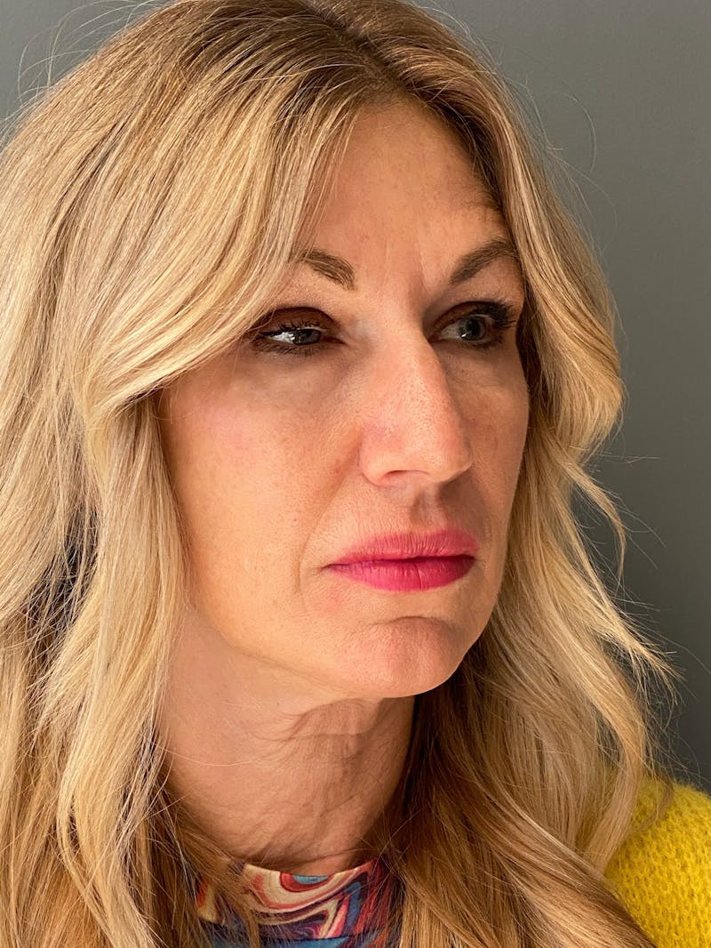 Deep Plane Facelift Before & After Gallery - Patient 212970 - Image 3