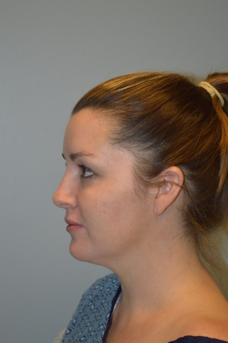 FaceTite (Non-Invasive Skin Tightening) Before & After Gallery - Patient 334172 - Image 7