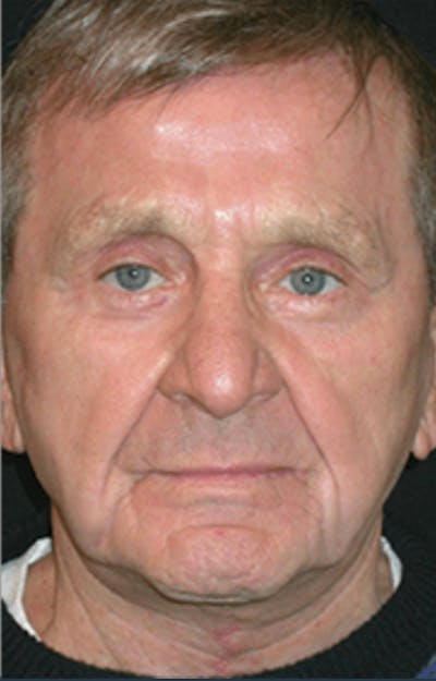 Facelift Before & After Gallery - Patient 106873 - Image 2