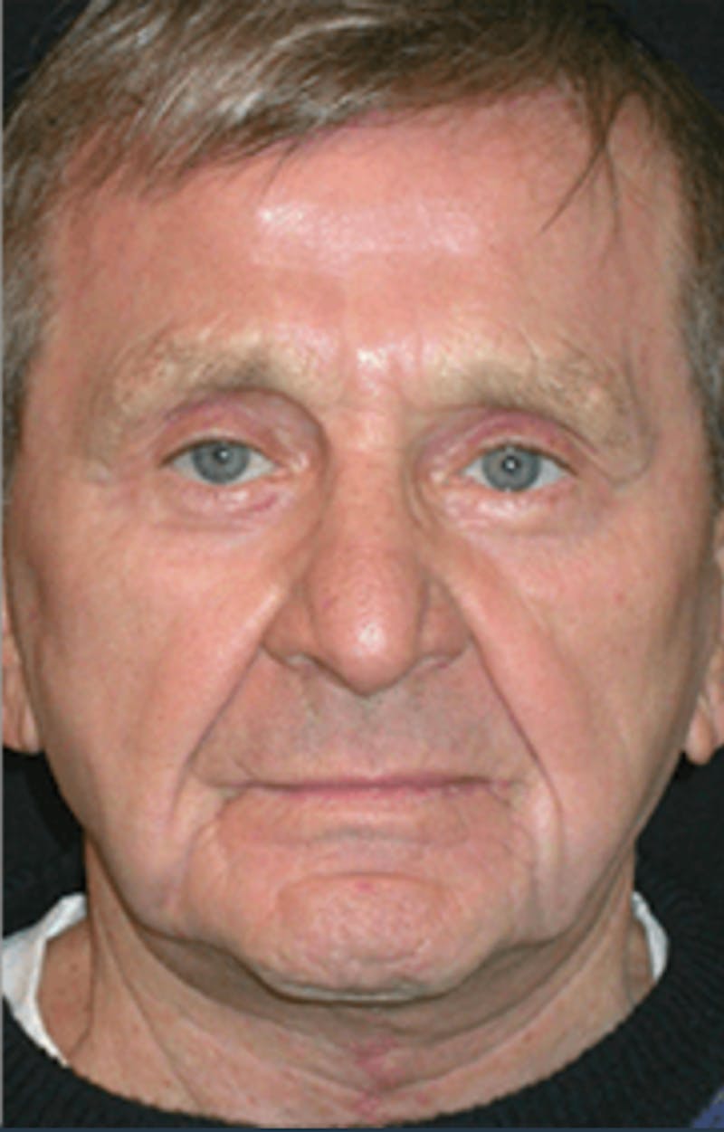 Facelift Before & After Gallery - Patient 106873 - Image 2