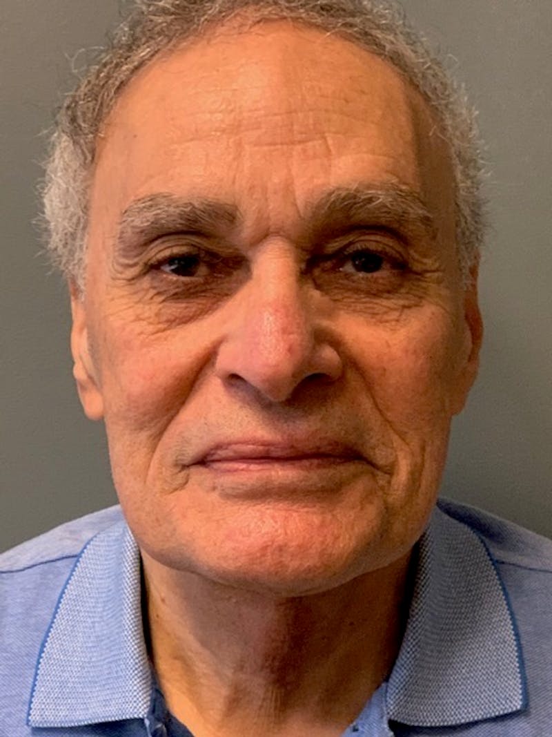 Neck Lift Before & After Gallery - Patient 291478 - Image 6