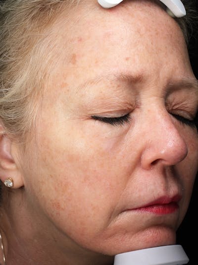 Lasers & Light Before & After Gallery - Patient 399518 - Image 1