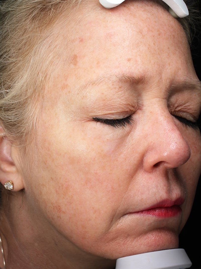 Lasers & Light Before & After Gallery - Patient 399518 - Image 1