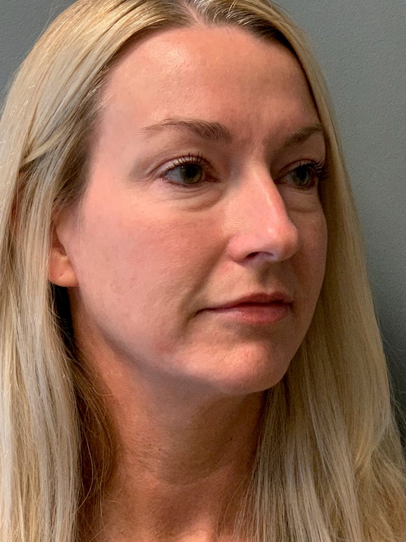 Blepharoplasty Before & After Gallery - Patient 387357 - Image 3