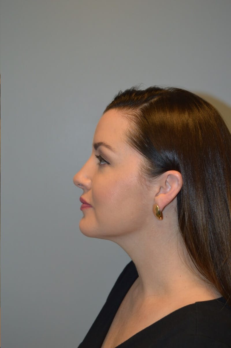 FaceTite (Non-Invasive Skin Tightening) Before & After Gallery - Patient 334172 - Image 8