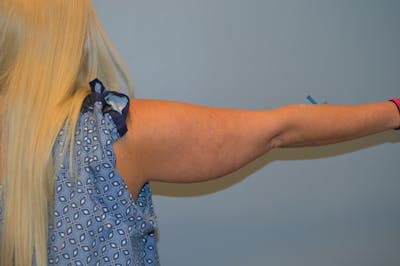 BodyTite (Scarless Skin Tightening) Before & After Gallery - Patient 393544 - Image 1