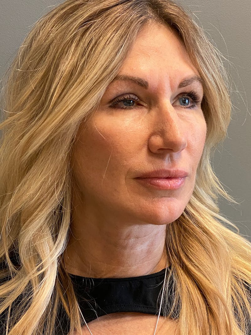 Deep Plane Facelift Before & After Gallery - Patient 212970 - Image 4