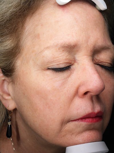 Lasers & Light Before & After Gallery - Patient 399518 - Image 2