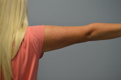 BodyTite (Scarless Skin Tightening) Before & After Gallery - Patient 393544 - Image 2