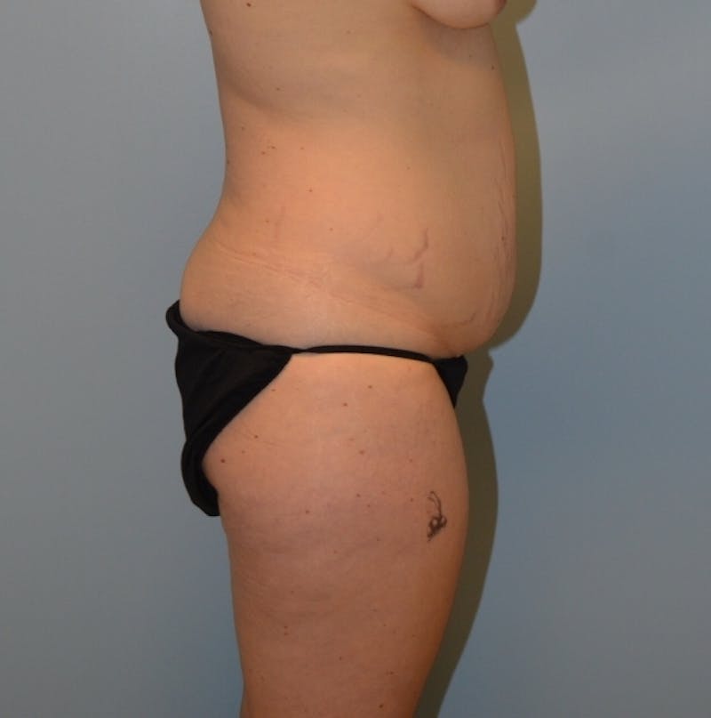 Tummy Tuck Before & After Gallery - Patient 429423 - Image 5