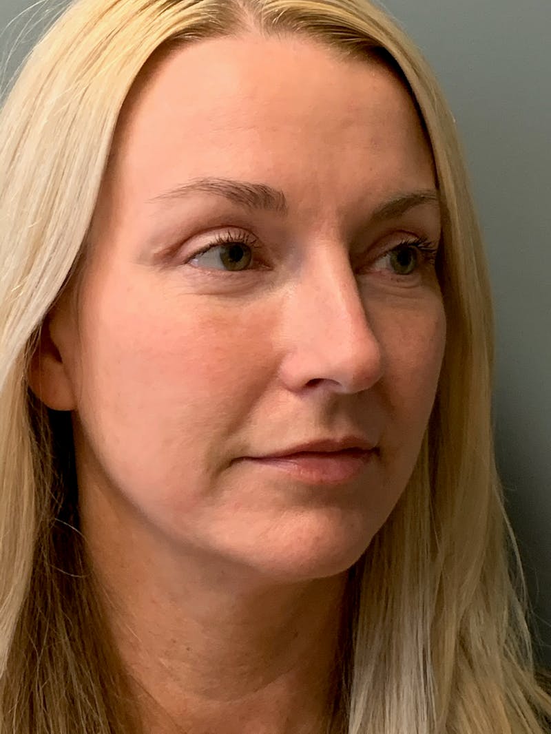 Blepharoplasty Before & After Gallery - Patient 387357 - Image 4