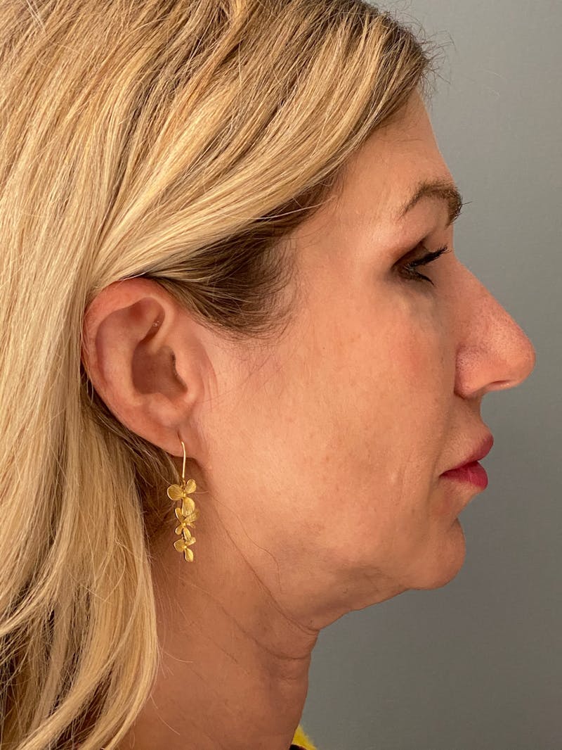 Deep Plane Facelift Before & After Gallery - Patient 212970 - Image 5