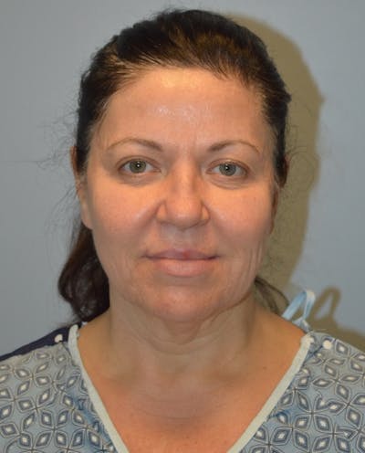 Facelift Before & After Gallery - Patient 254175 - Image 1