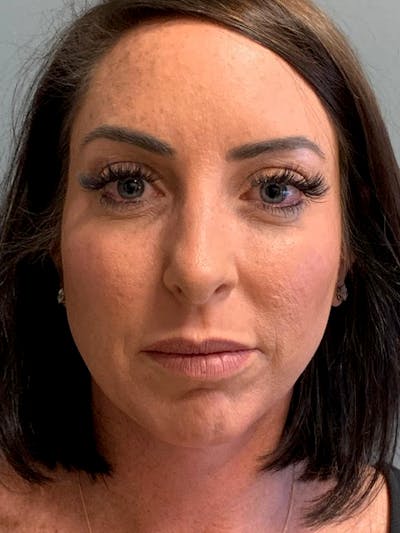 Neck Lift Before & After Gallery - Patient 413026 - Image 2