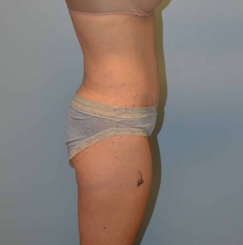 Tummy Tuck Before & After Gallery - Patient 429423 - Image 6