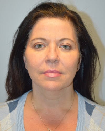 Facelift Before & After Gallery - Patient 254175 - Image 2