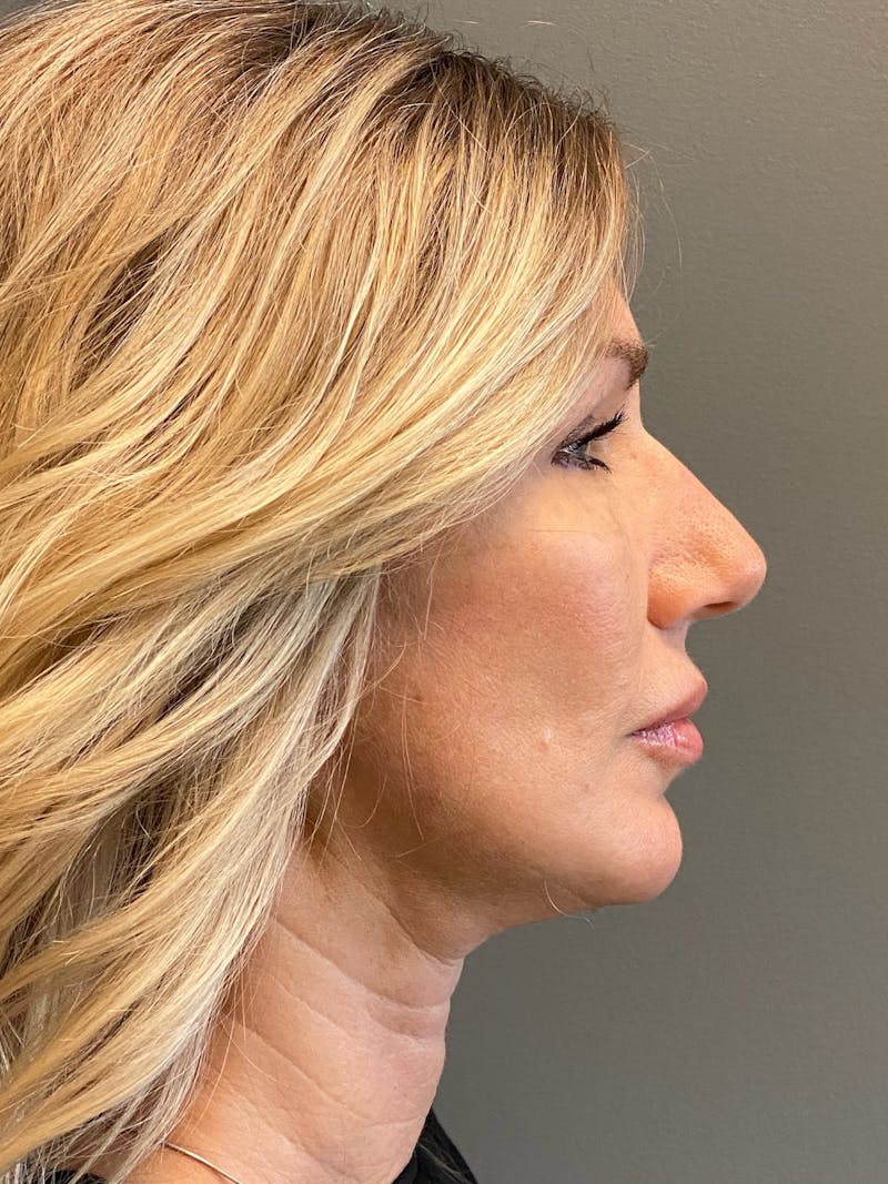 Deep Plane Facelift Before & After Gallery - Patient 212970 - Image 6